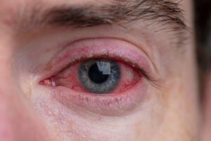 Allergic Conjunctivitis
