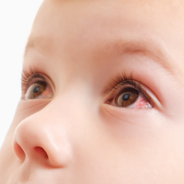 Une douleur dans l'œil de l'enfant que faire — free download
