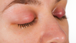 What are the causes of chalazion? Close-up of a woman's eyes with a chalazion on the left eye.