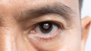 What to do in the event of an early cataract ? An zoom of an eye with an early cataract.